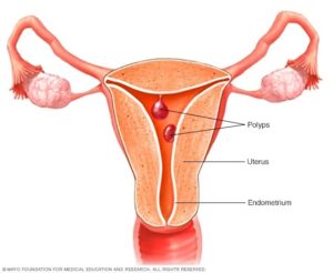 uterine-polyps-vs-fibroids